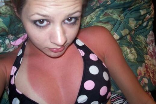 Randon sun burn women sunburn sunburnt pt