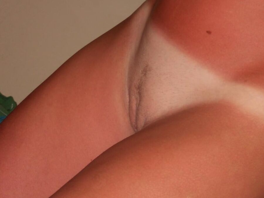 Randon sun burn women sunburn sunburnt pt