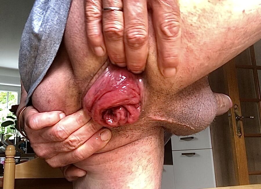 anal stretching and prolapse