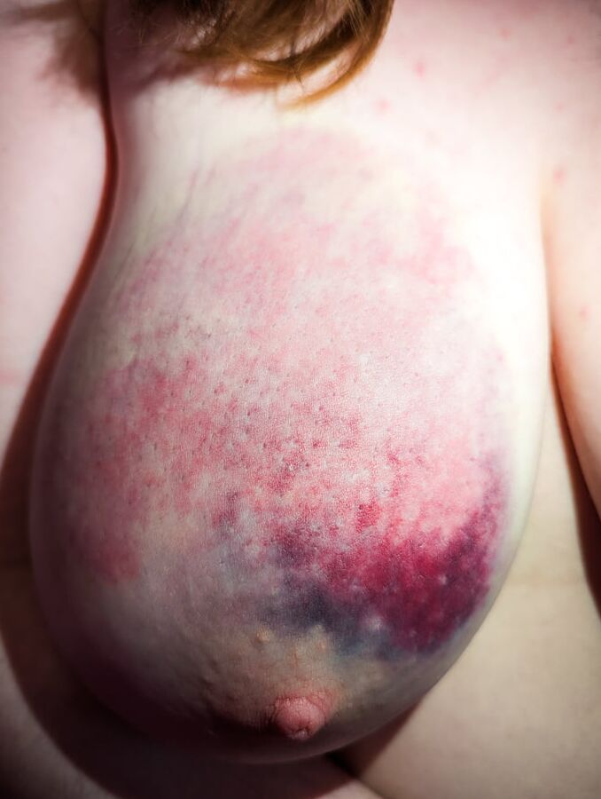 My Bruised Tits After A Rough BDSM Session Nudedworld