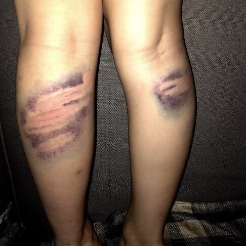 Marked girls