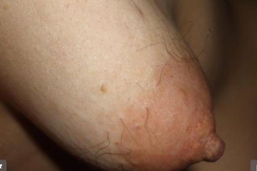 Hairy nipples