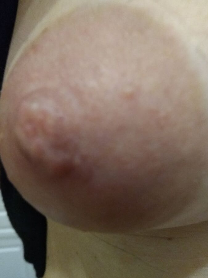 Hairy nipples