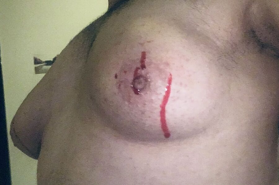 saline injection