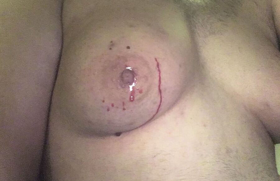 saline injection