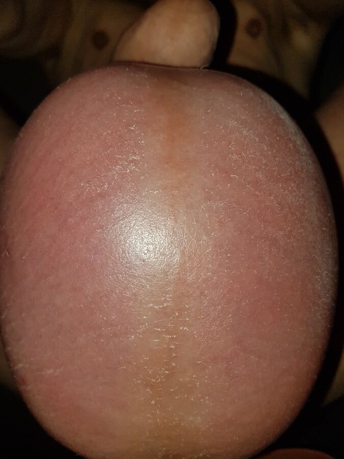 Saline Sack