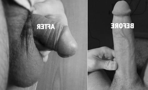 Dick shrinking