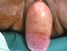 UTERINE PROLAPSE