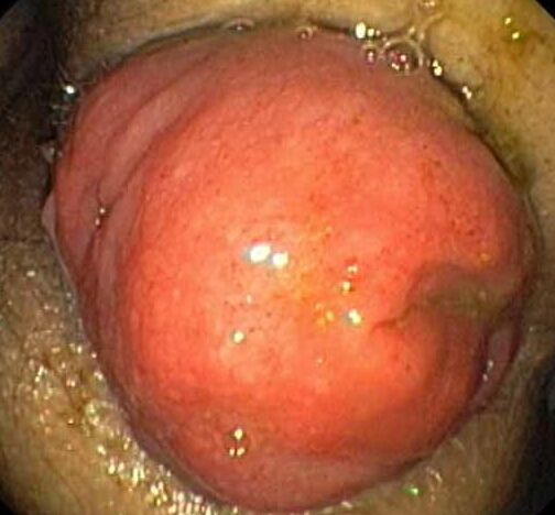 UTERINE PROLAPSE