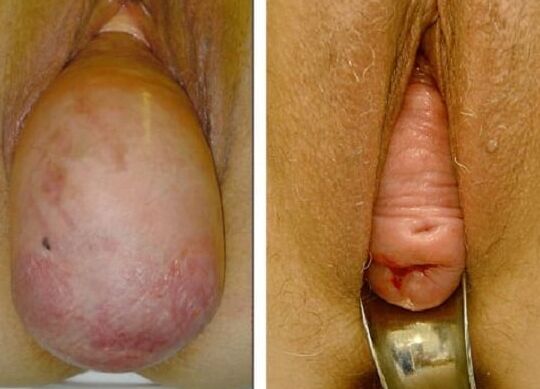 UTERINE PROLAPSE