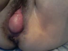 UTERINE PROLAPSE