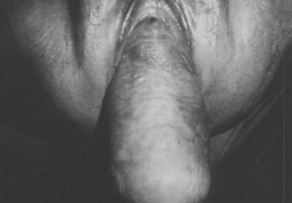 UTERINE PROLAPSE