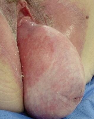 UTERINE PROLAPSE