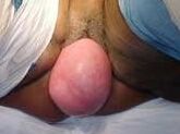 UTERINE PROLAPSE