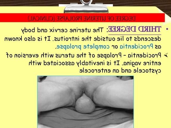 UTERINE PROLAPSE