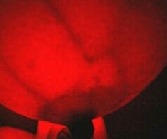 Breast transillumination test