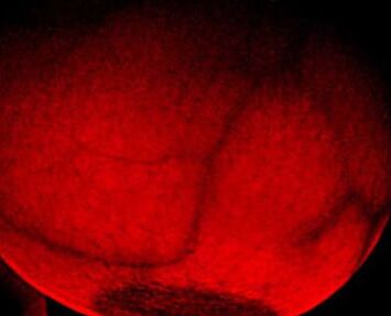 Breast transillumination test