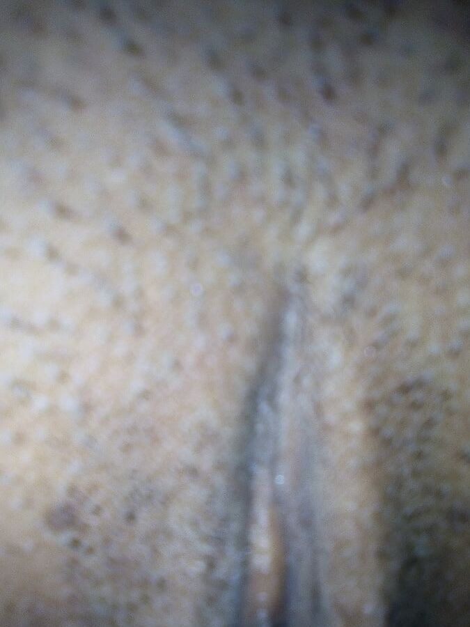 COROA BUCETUDA