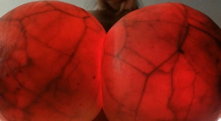Breast transillumination test