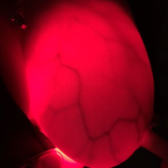 Breast transillumination test
