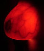 Breast transillumination test