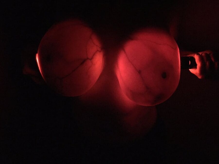 Breast transillumination test