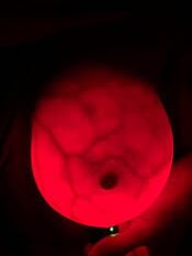 Breast transillumination test