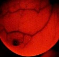 Breast transillumination test