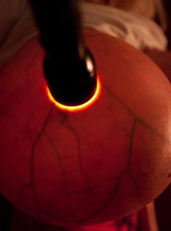 Breast transillumination test