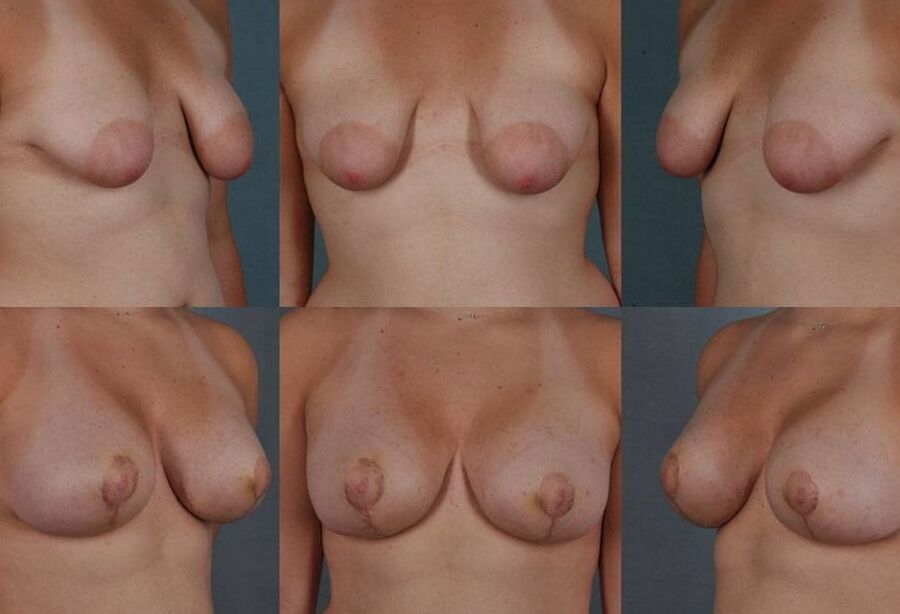 Breastredution turns me on!