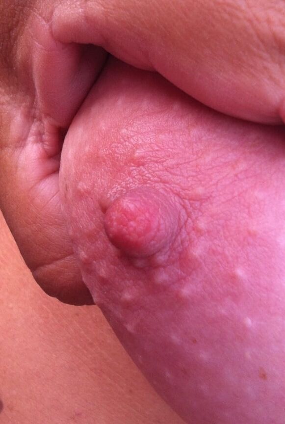 Nipples