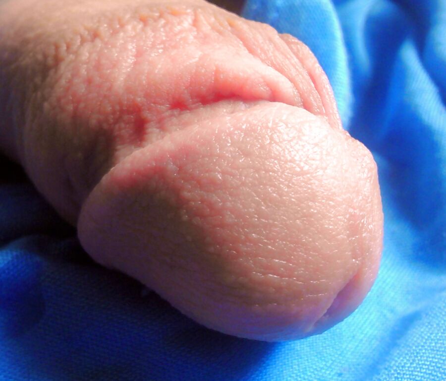 Circumcised penis