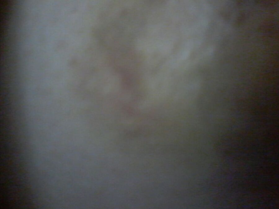 Chirurgy cyst