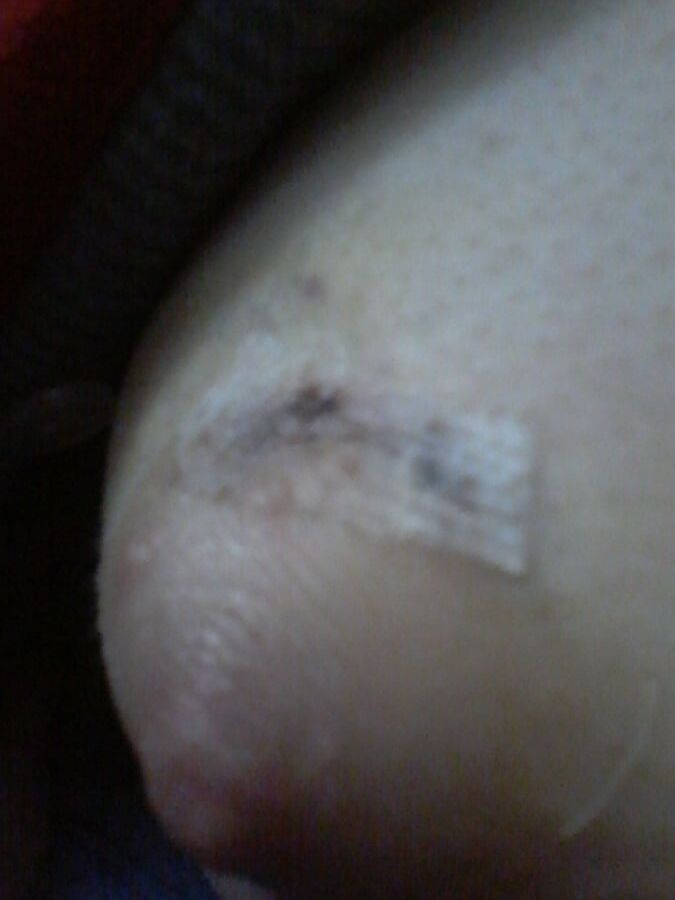 Chirurgy cyst