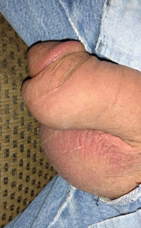 Circumcised penis