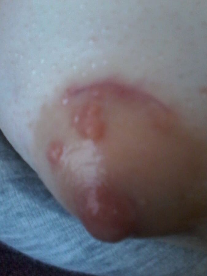 Chirurgy cyst