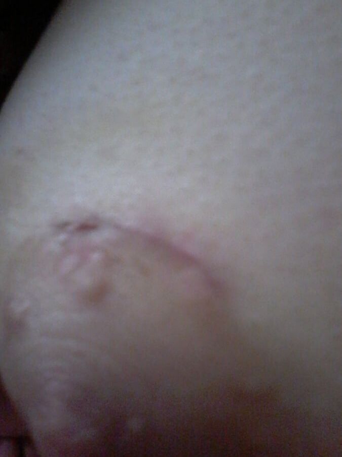 Chirurgy cyst