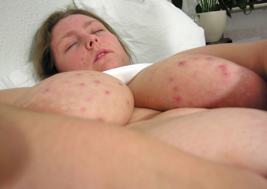 Lovely BBW Model With Acne Tits