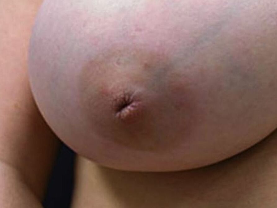 inverted nipple