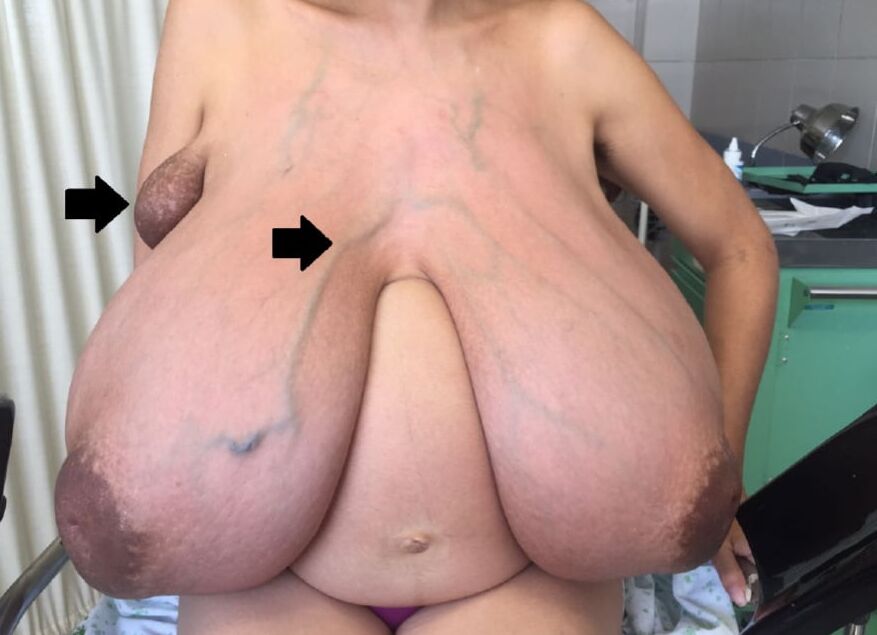Biggest Monster macromastia