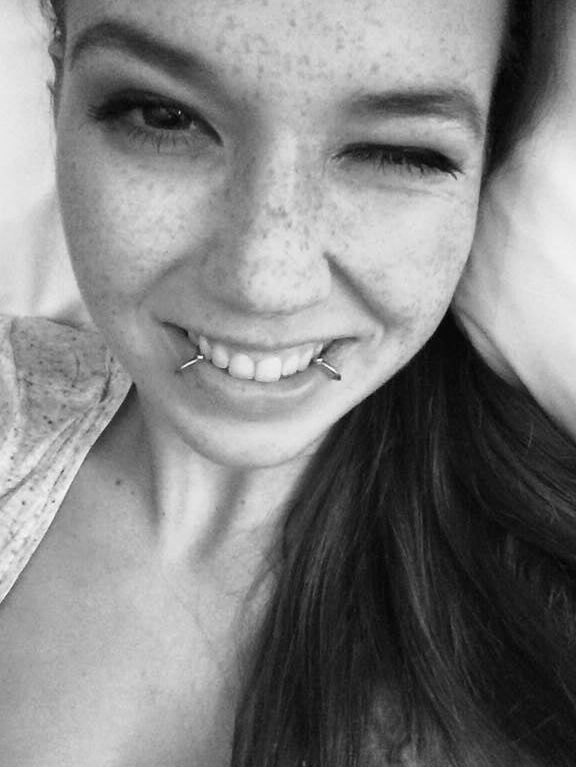 Freckles