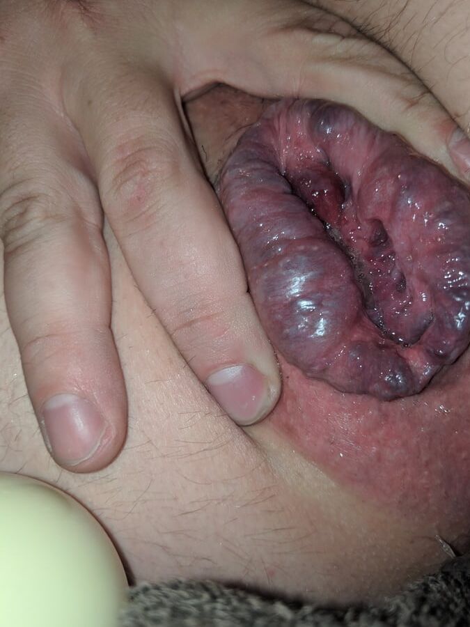 gape