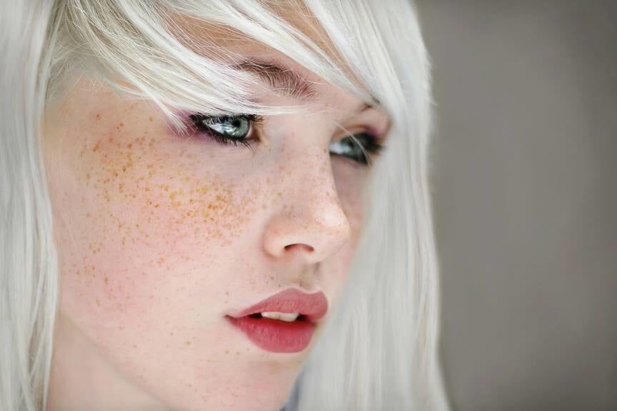 Freckles