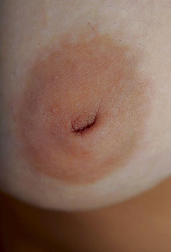 inverted nipple