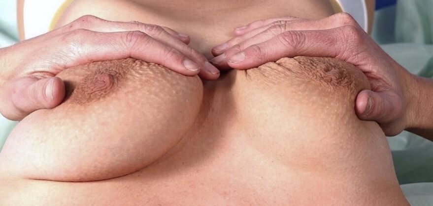 inverted nipple