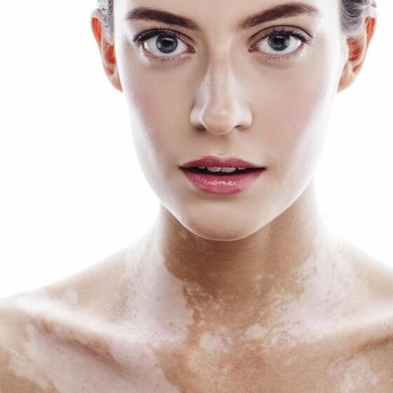 Freckles