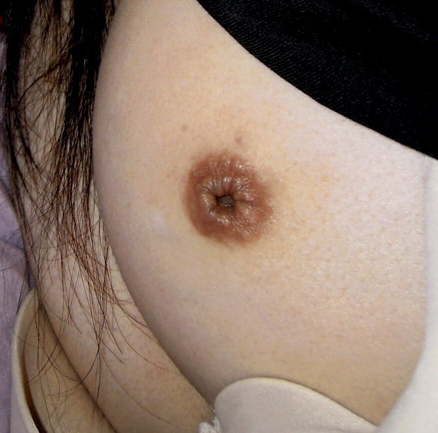 inverted nipple