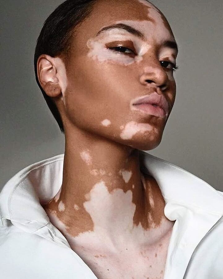 Freckles