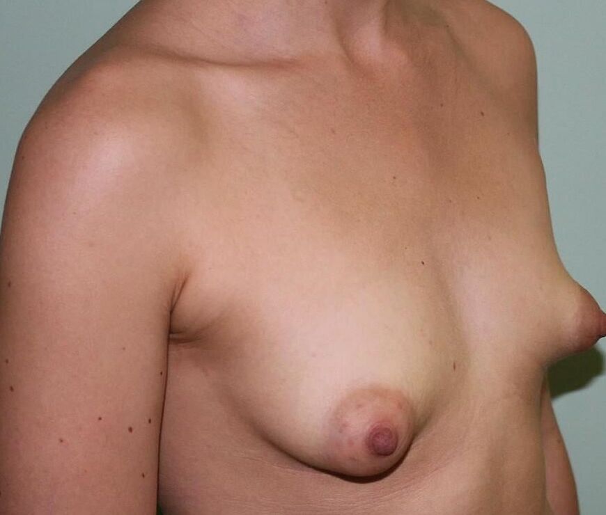 Huge Amateur Areola