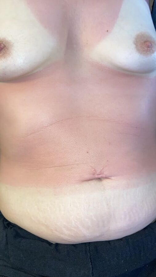 WHORE SUNBURNT!!